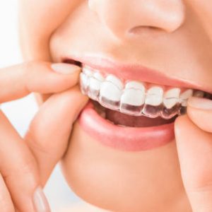 Braces Care Kit